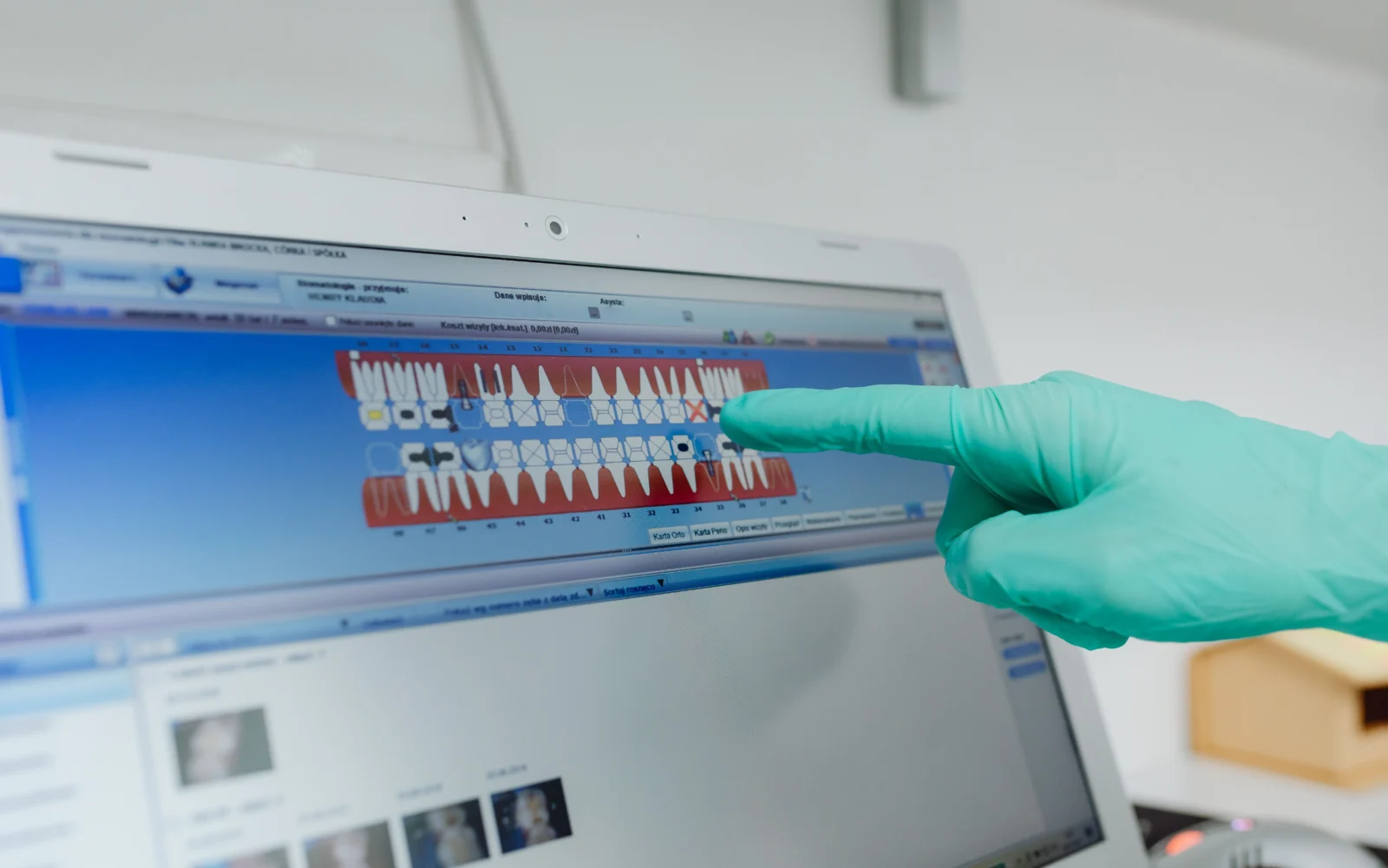 Software odontoiatrico utilizzato nella pianificazione implantare computer-assistita