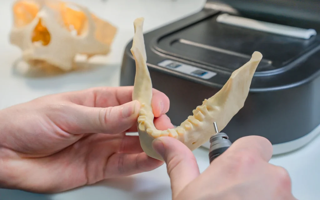 Modello dentale 3D utilizzato in un flusso digitale per guide chirurgiche stereolitografiche
