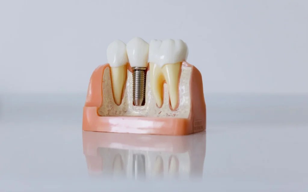 Modello di impianto dentale per articolo sulla connessione conometrica Morse e platform switching