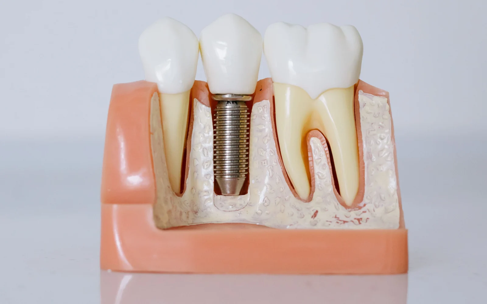 Modello di impianto dentale per articolo su Morse Taper, platform switching e perdita ossea peri-implantare