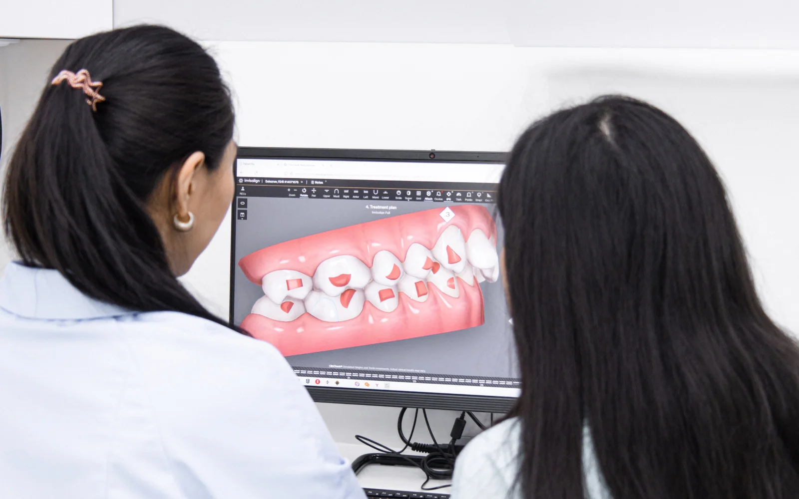 Pianificazione digitale ortodontica su modello dentale 3D per guida chirurgica CAD/CAM