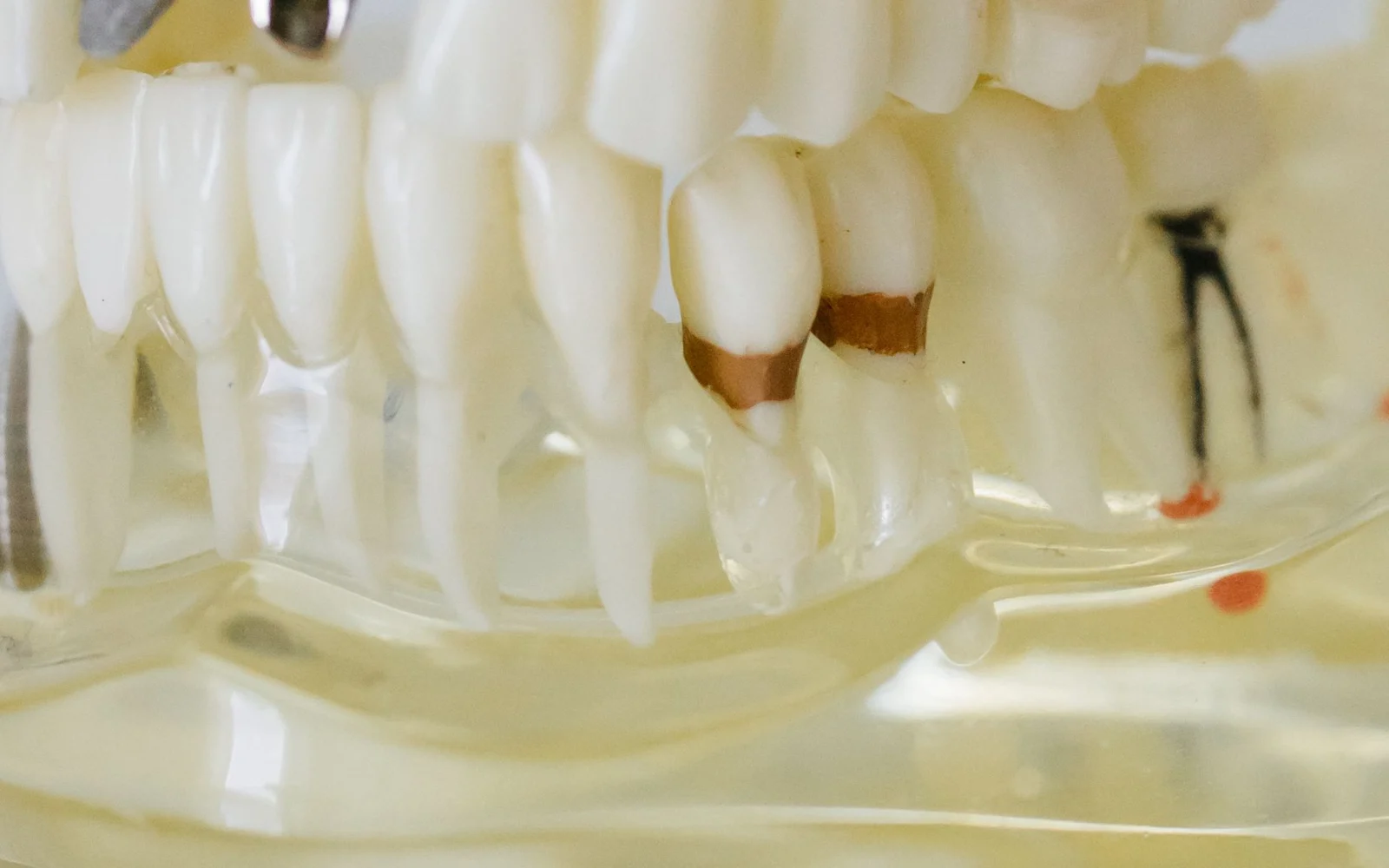 Modello anatomico dentale con impianto per studio dei tessuti peri-implantari