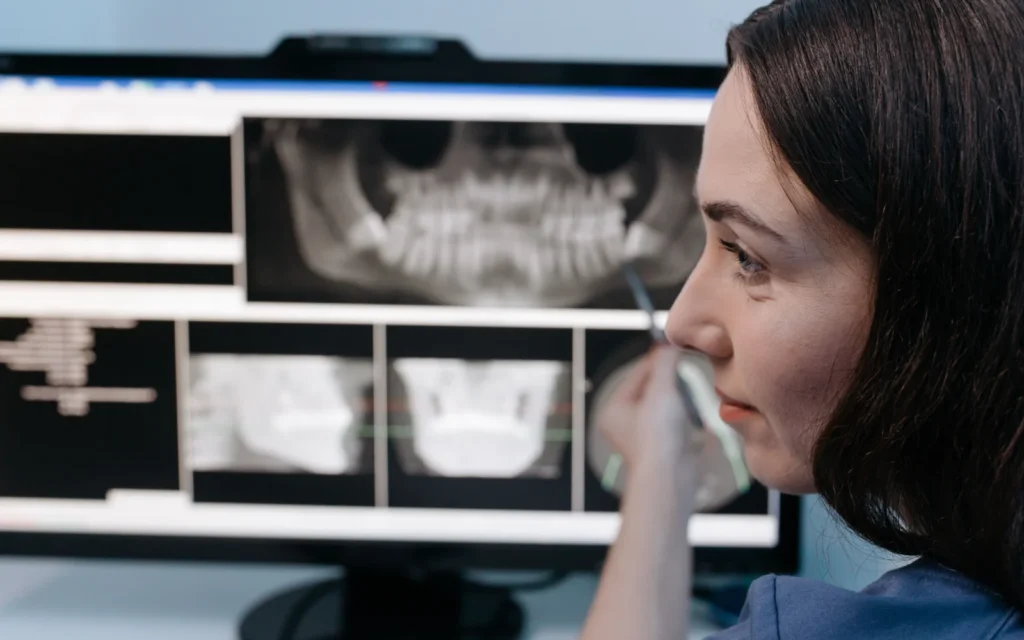 Radiografia panoramica utilizzata per la valutazione dei molari mandibolari inclusi