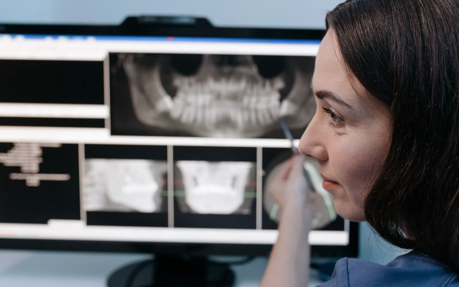 Radiografia panoramica utilizzata per la valutazione dei molari mandibolari inclusi