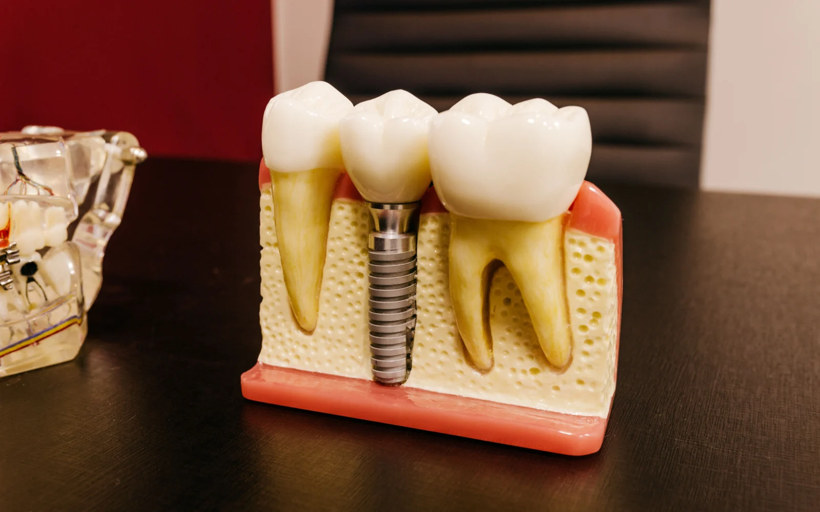 Modello anatomico con impianto dentale per studio dell’accuratezza implantare